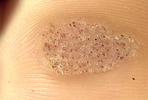 Same Same But Different Warts - The Sole Clinic