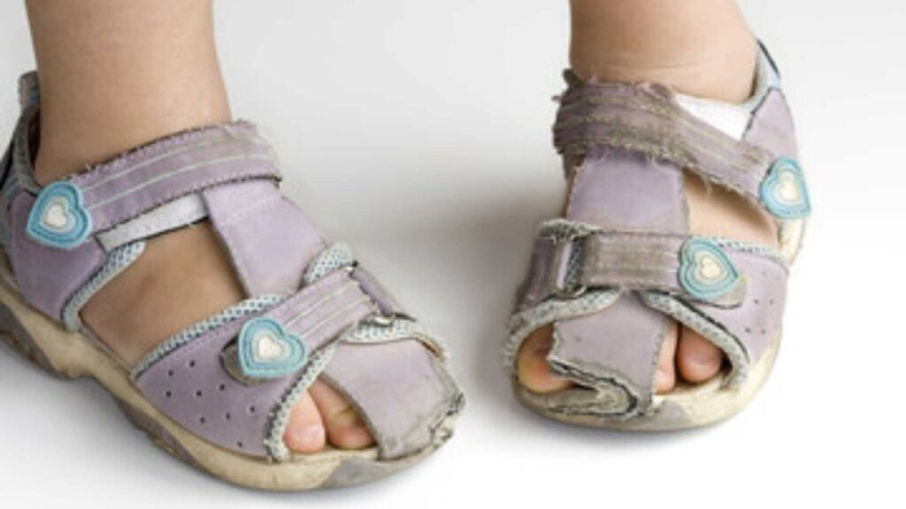 A close-up image of a child's feet with Paediatric In-Toeing, wearing worn-out purple sandals with visible signs of wear and tear, emphasizing improper footwear conditions.