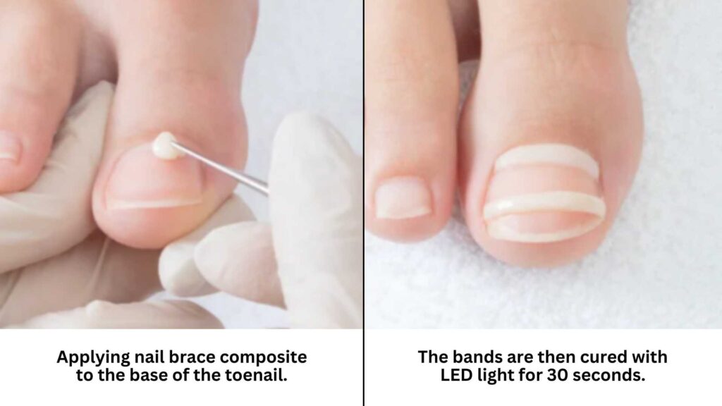 Application of nail bracing composite to the toenail base, followed by curing with LED light for effective correction.