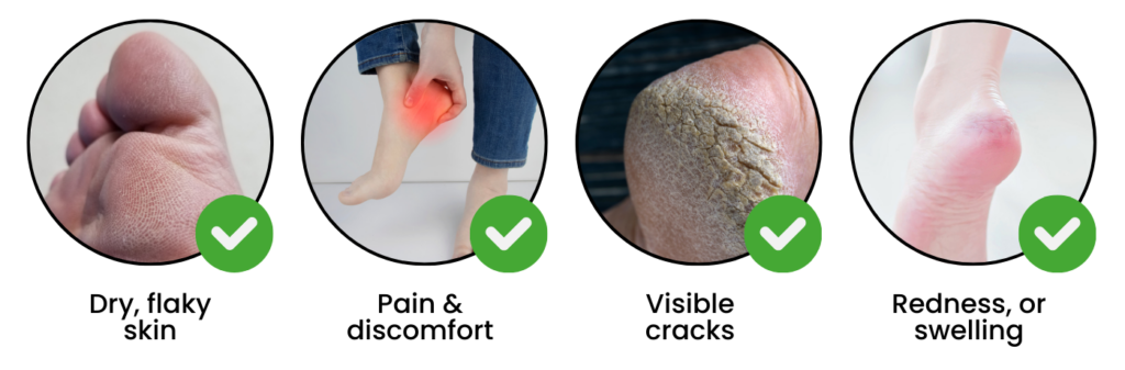 Visual representation of cracked heel symptoms including dry, flaky skin, pain and discomfort, visible cracks, and redness or swelling, each illustrated with a corresponding image and green checkmark for identification.