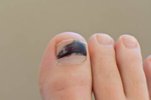 Close-up of a bruised toenail showing discolouration, often caused by trauma or pressure, highlighting common foot injuries.