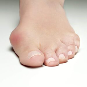 a closeup of person's foot with a bunion
