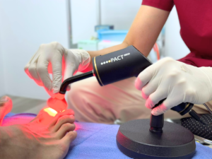PACT photodynamic light therapy being applied to a patient's toenail to treat a fungal nail infection. The process uses red light and a photosensitive gel for safe, non-invasive fungal nail removal.