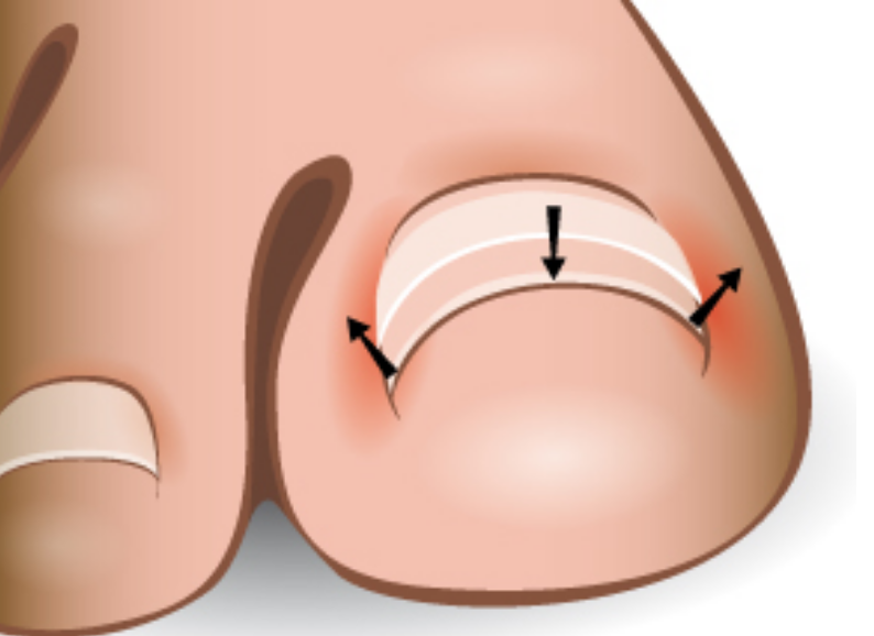 An illustrated close-up of a toenail with ingrown edges, highlighting the areas of redness and pressure caused by the curved nail.