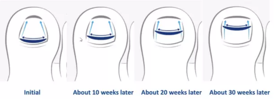 A progression diagram illustrating the stages of nail bracing for ingrown toenails over 30 weeks, showing gradual correction of the nail curvature