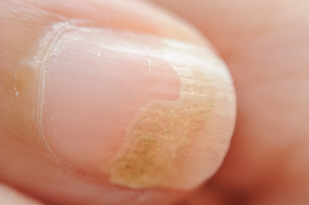 Chloronychia: green nail syndrome caused by Pseudomonas aeruginosa in  elderly persons. - Abstract - Europe PMC
