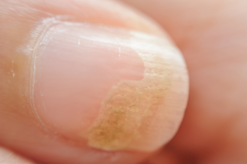 White Spots and Nail Fungus Treatments, Anne Arundel Dermatology