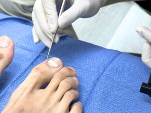 Close-up of a podiatrist performing nail bracing for ingrown toenails on a patient, showcasing safe and non-surgical toenail treatment in Singapore.