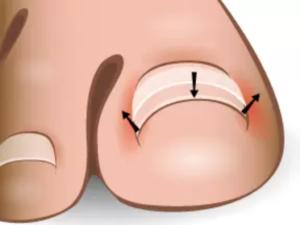 ingrown toenail treatment