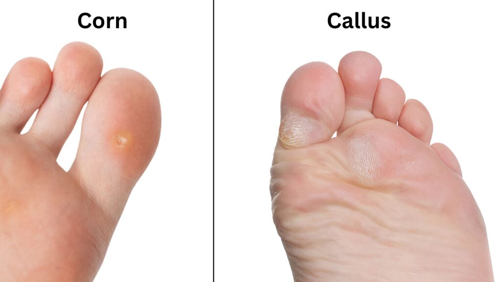 2 image comparing corn and callus on the feet