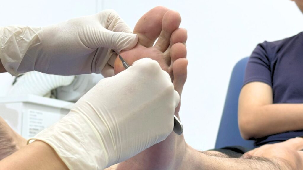 A podiatrist treating a patient's foot for corns and calluses, demonstrating professional care and precision.