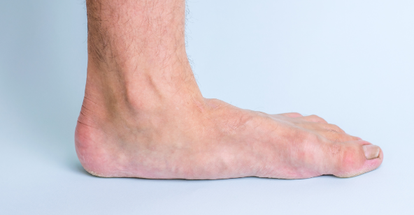 Close-up of a person's foot with flat arches, illustrating the condition of flat feet (fallen arches) and its impact on foot structure and alignment.