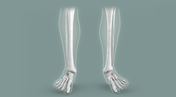 Comparison of normal and misaligned lower limbs, showcasing skeletal structure and foot positioning. This image highlights differences in alignment, often associated with conditions such as flat feet, pronation, or other biomechanical issues.