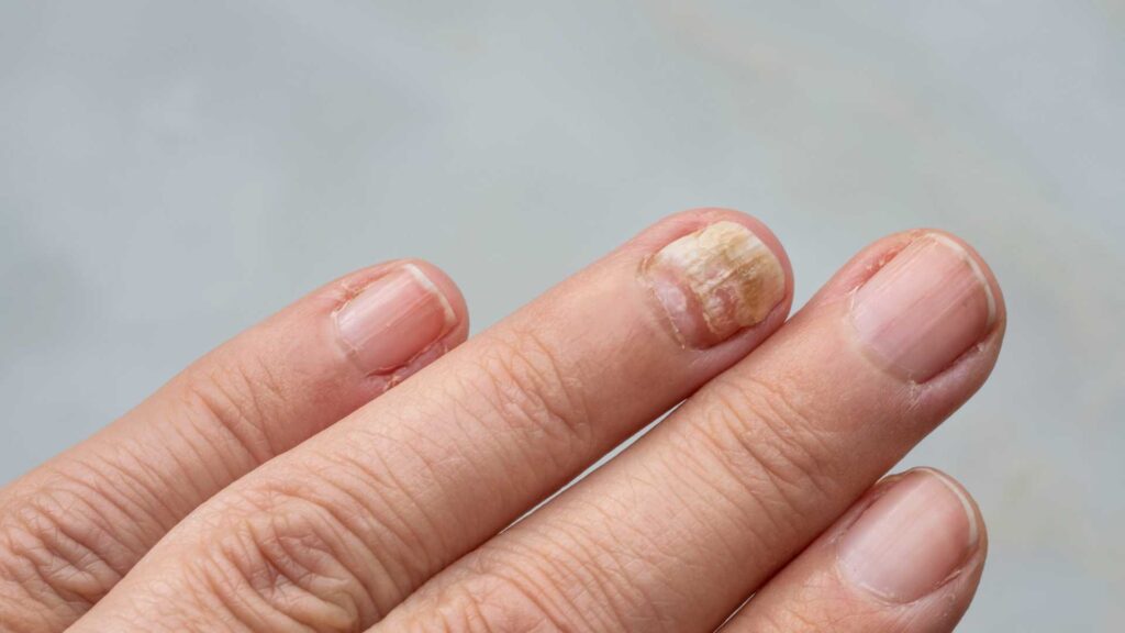 A close-up of a person's hand showing a fingernail with signs of fungal nail infection (onychomycosis). The affected nail appears thickened, discolored, and brittle, with a yellowish-brown hue and rough texture. The surrounding nails look relatively healthy. Keywords: Fungal Nail, Fingernail Infection, Onychomycosis, Nail Health, Brittle Nails, Discolored Nails.