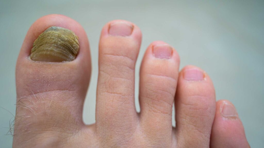 A close-up of a person's foot, highlighting a severely thickened, discolored, and brittle toenail on the big toe, characteristic of advanced fungal nail infection (onychomycosis). The nail appears yellowish-brown with a rough, ridged texture. The surrounding nails look healthy. Keywords: Fungal Nail, Onychomycosis, Toenail Infection, Thickened Nails, Discolored Nails, Nail Fungus Treatment, Foot Health.