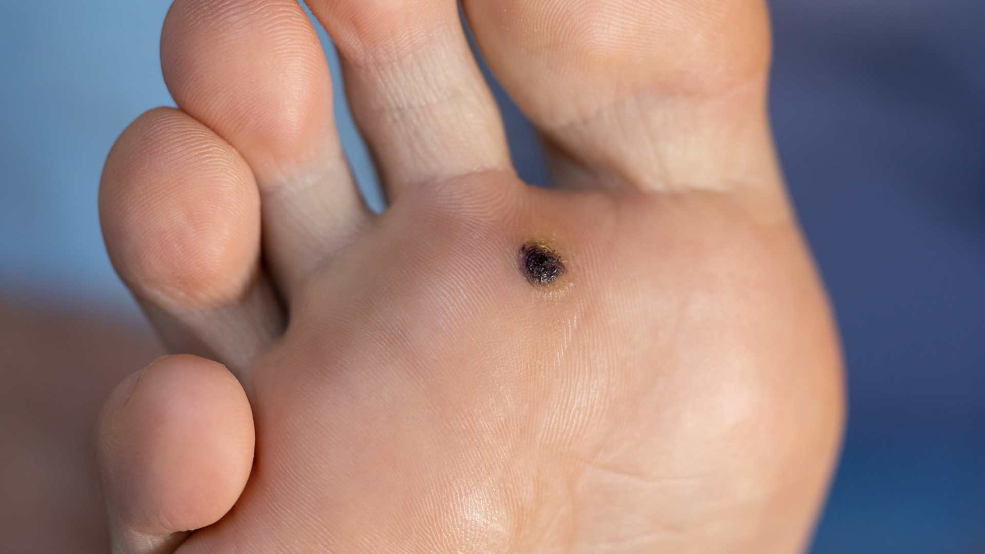 Close-up image of a plantar wart on the sole of a foot, showing a small, darkened lesion commonly caused by the human papillomavirus (HPV). Plantar warts can be painful and require proper treatment from a podiatrist for effective removal.