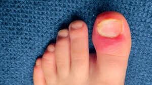 Close-up of an inflamed big toe with visible redness and swelling around the nail, showing signs of an ingrown toenail