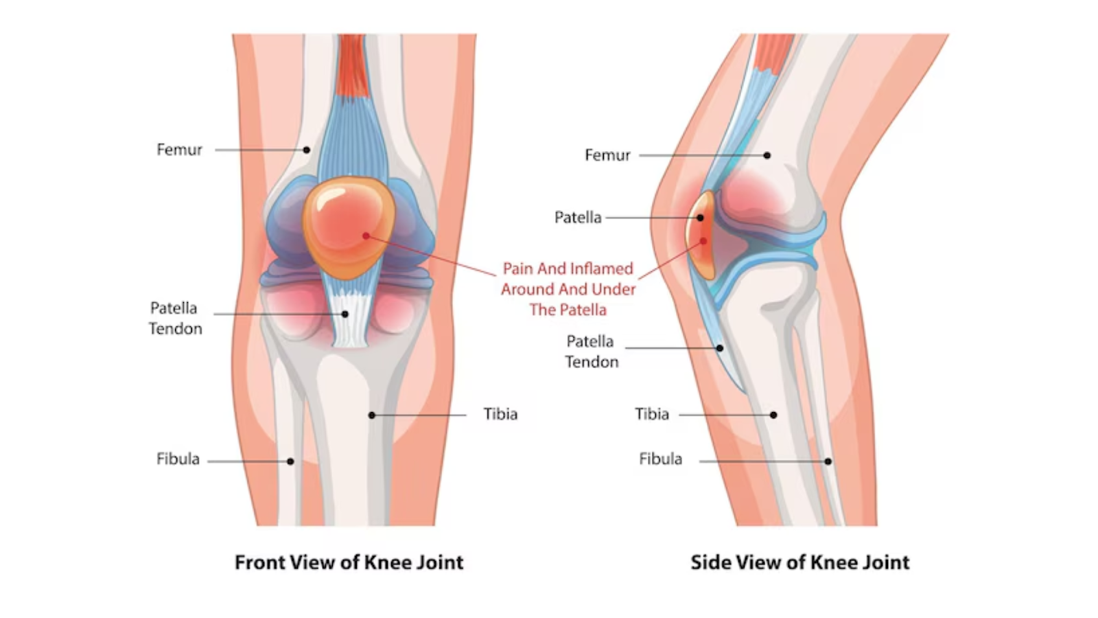 Anatomical illustration of runner’s knee pain location.