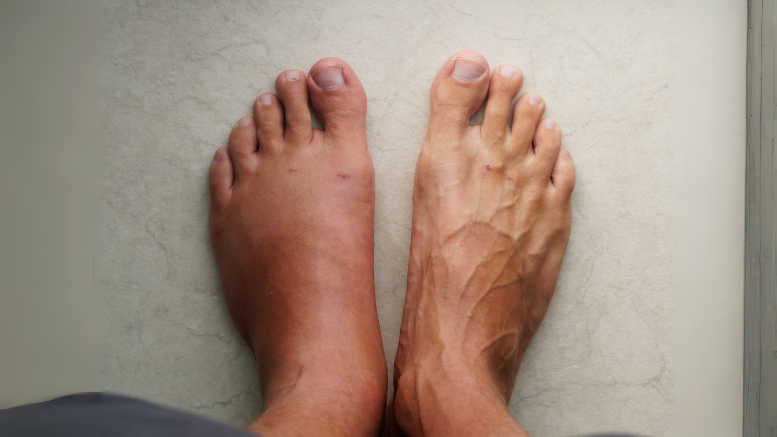Comparison of swollen and normal feet in a senior patient – possible sign of foot inflammation or arthritis