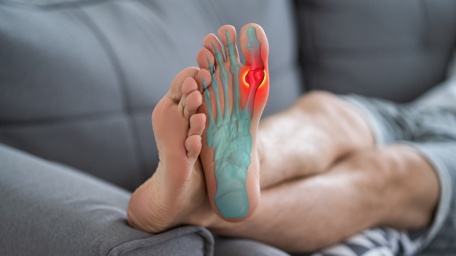  Visual of foot bones with a red-highlighted bunion, indicating joint changes due to osteoarthritis.