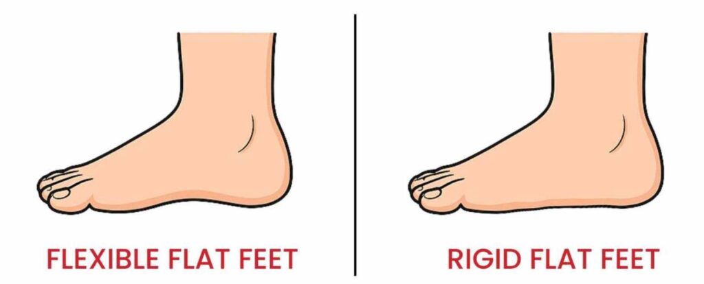 Side-by-side comparison of flexible flat feet vs. rigid flat feet in children.