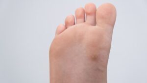 Close-up of a child’s foot showing a plantar wart – podiatry treatment can relieve discomfort and prevent worsening in active kids.