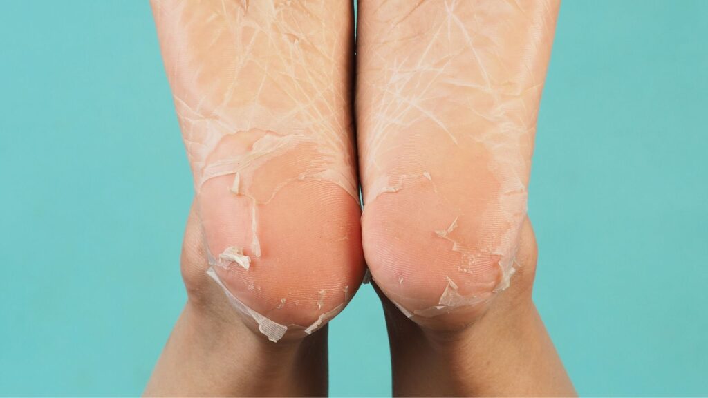 Peeling skin on heel area, common sign of children's feet peeling issues