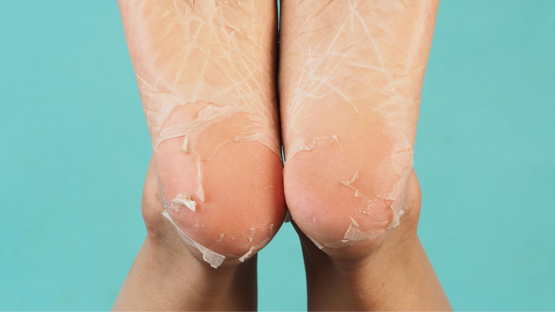 Peeling skin on heel area, common sign of children's feet peeling issues