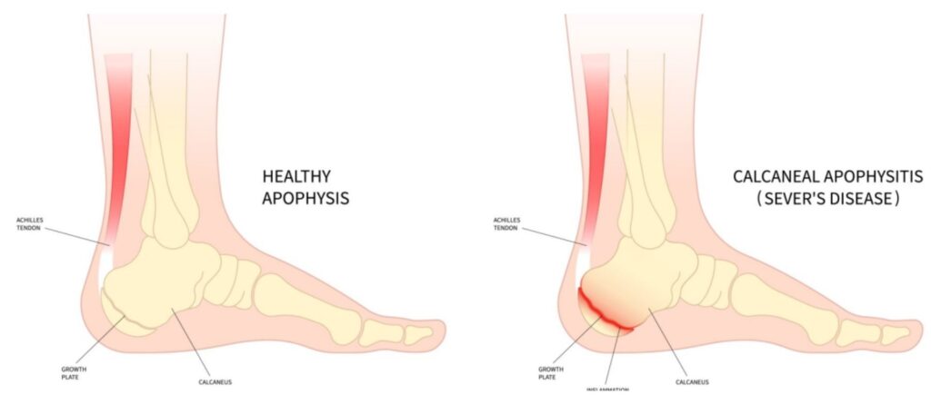 Side-by-side medical illustration comparing healthy heel anatomy and inflammation in Sever’s Disease.