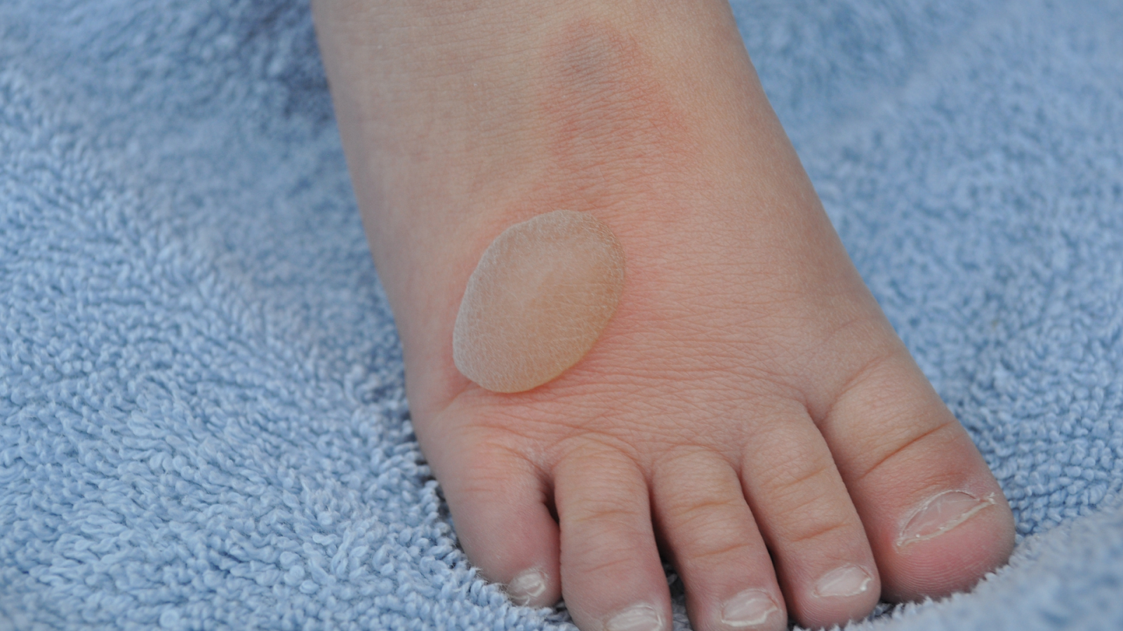 Close-up of a child's foot with a blister or skin patch, possibly due to infection or friction