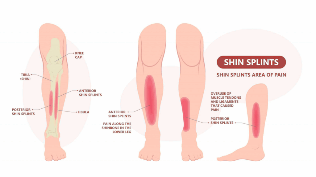 Shin splints areas of pain
