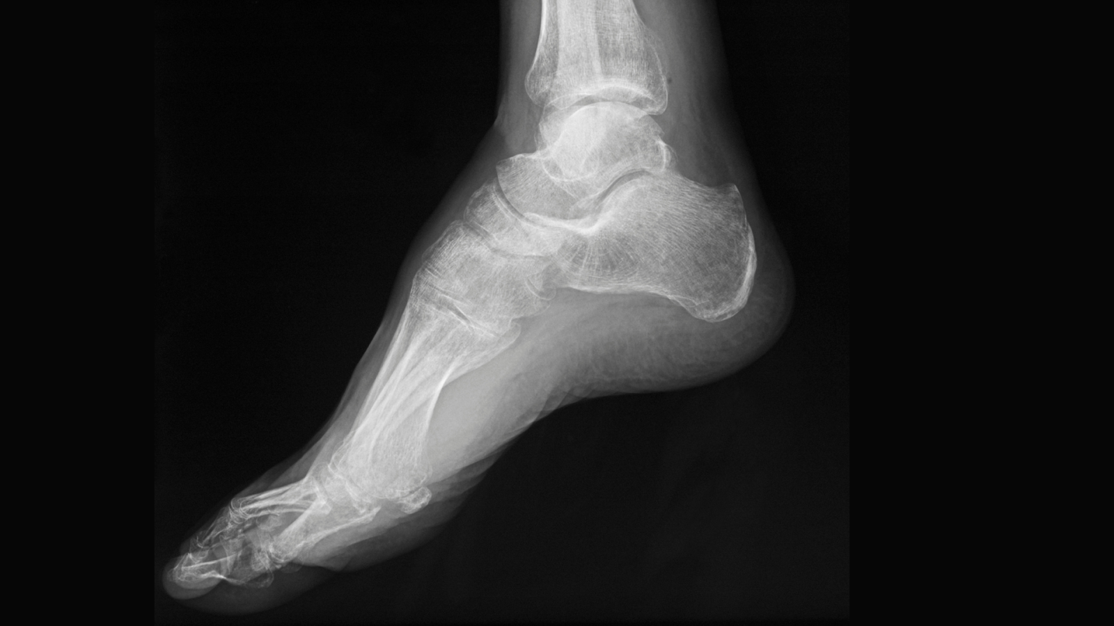 X-ray of a child’s foot showing heel anatomy and potential inflammation from Sever’s Disease.