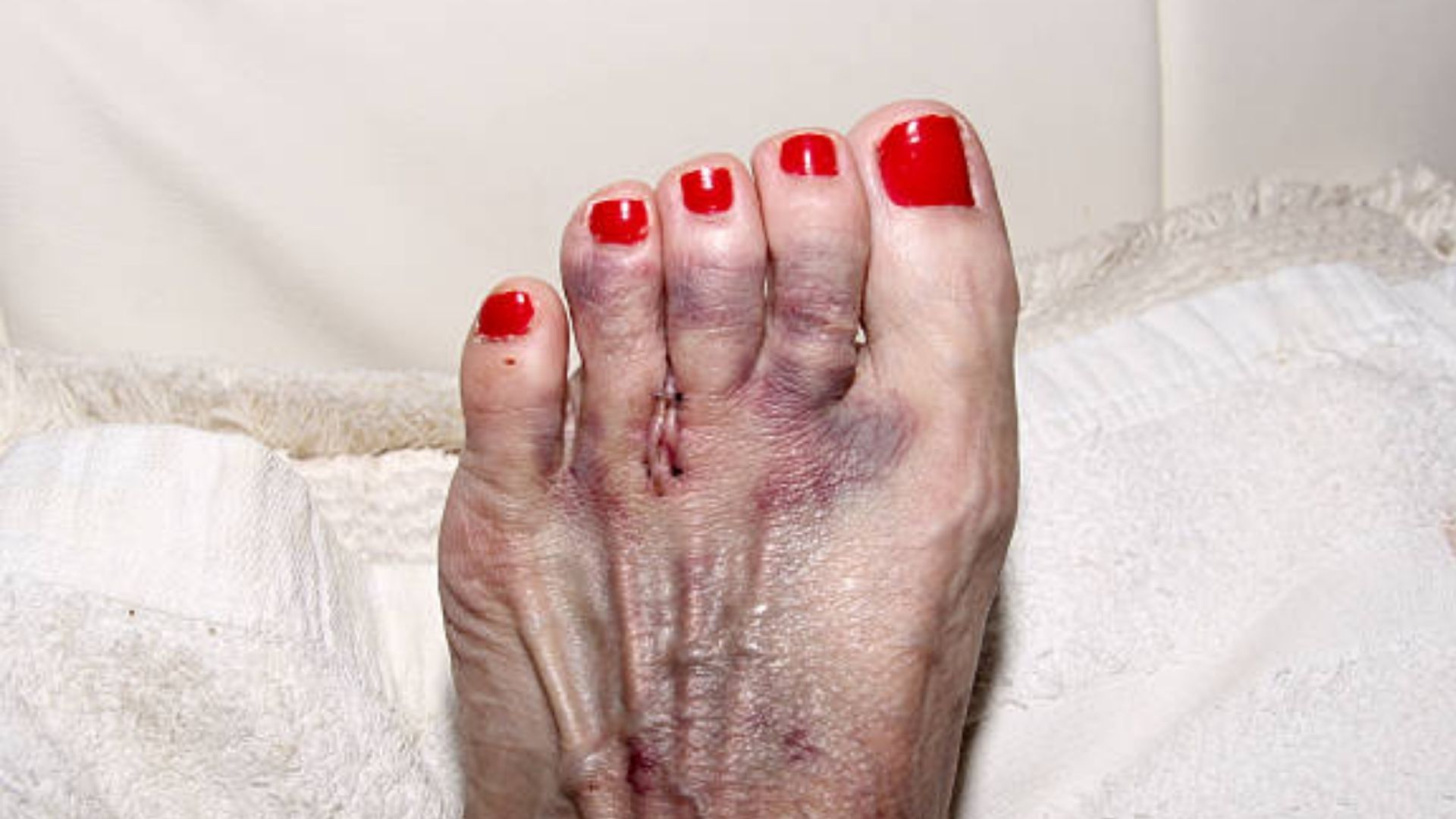 Healing foot after Morton's Neuroma surgery, showing bruising and incision.
