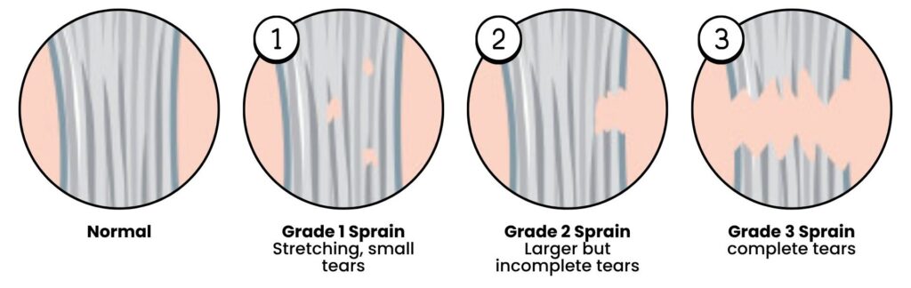 Grades of ankle sprains illustrated from mild to severe ligament damage.