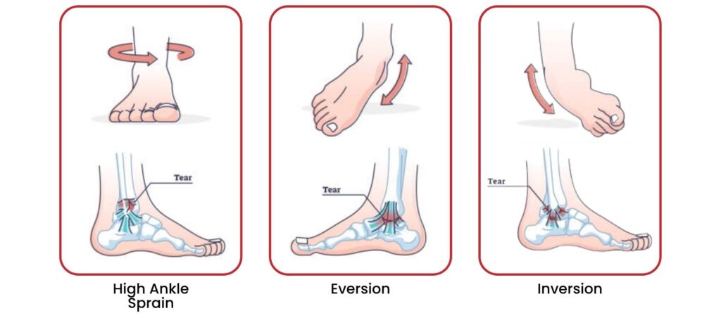 Illustration of different types of ankle sprains—high ankle, eversion, and inversion.