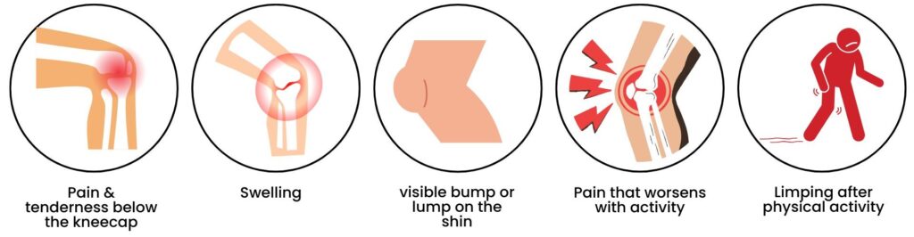 Diagram showing pain and swelling below the kneecap – a common symptom of Osgood-Schlatter’s Disease in children.