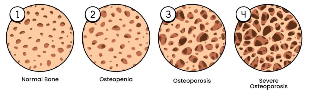 Visual chart showing bone density changes from normal to severe osteoporosis