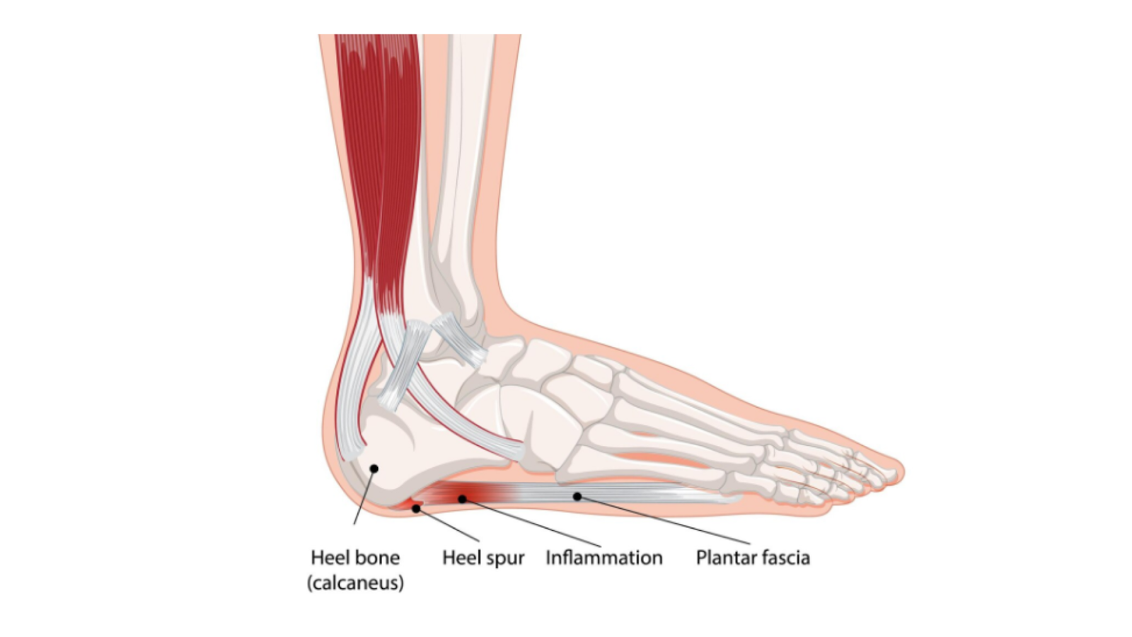 Medical diagram showing plantar fascia, heel spur, and inflammation of the heel