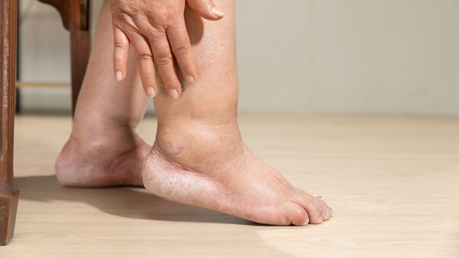 Elderly person with swollen ankle possibly indicating bone stress or fracture risk due to low bone density.