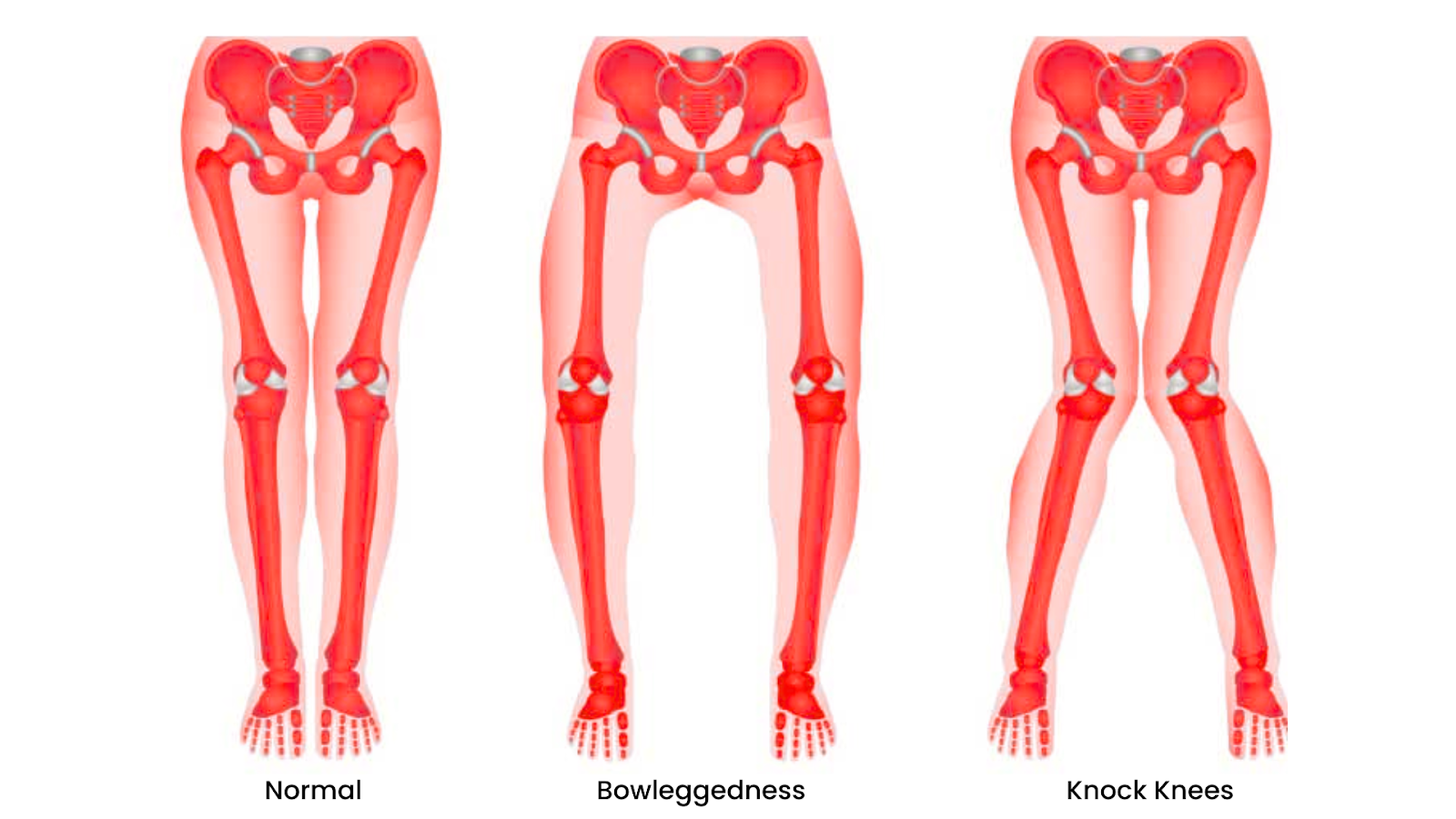 Diagram comparing normal legs, bowleggedness, and knock knees in children.