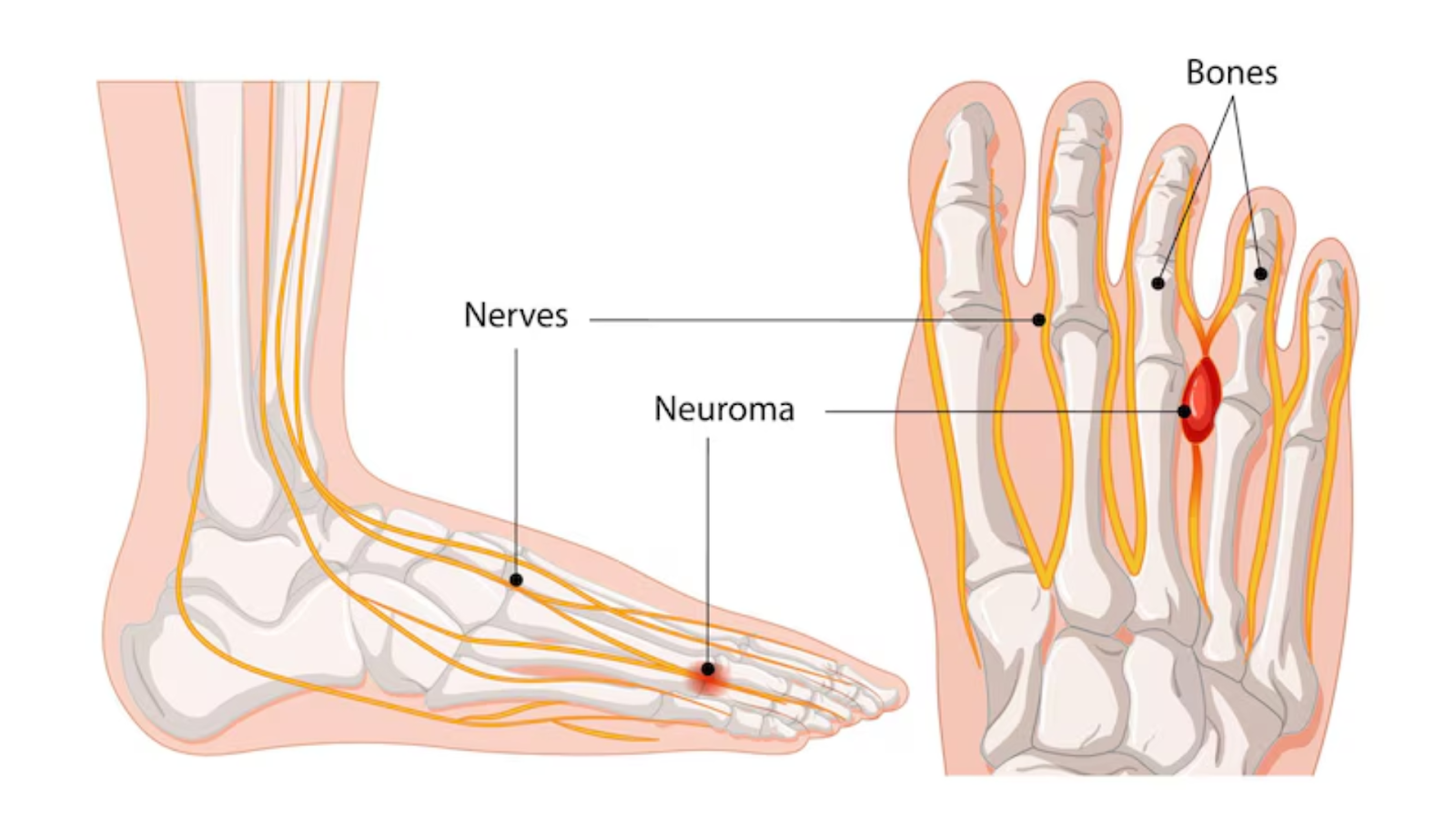 Medical diagram showing nerves and neuroma location in Morton's Neuroma.