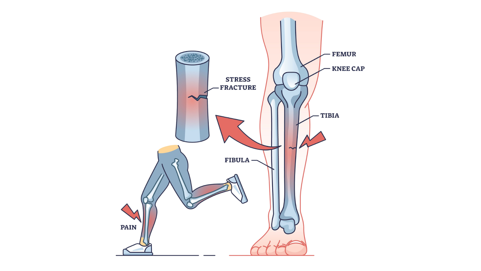 Diagram showing bone stress fracture locations and associated running pain.