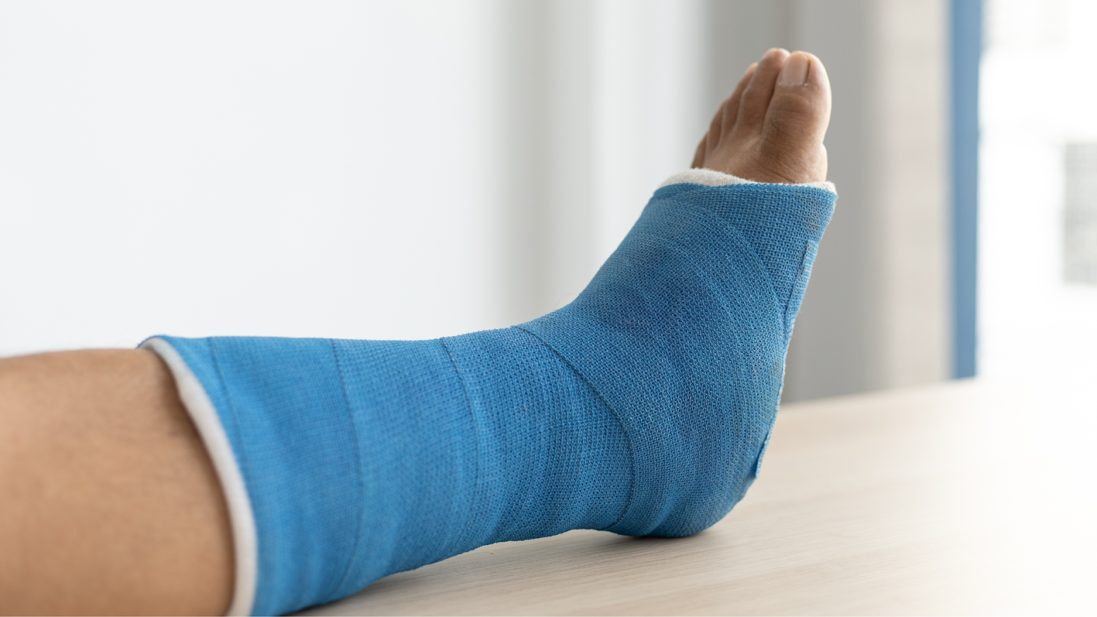 Close-up of foot in blue cast after injury, indicating recovery phase from a stress fracture.