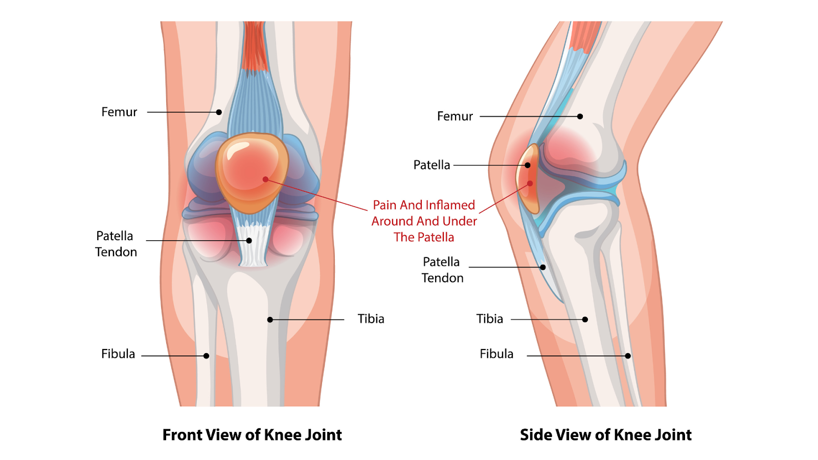 Medical diagram of the knee showing inflammation caused by patellofemoral pain syndrome