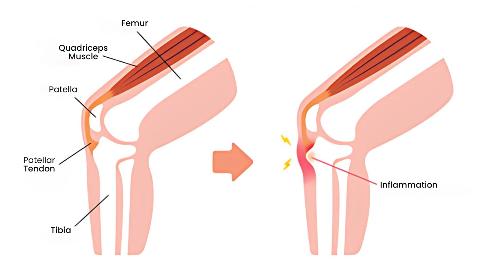 Anatomical illustration showing inflammation of the patellar tendon – a hallmark of Osgood-Schlatter’s Disease.