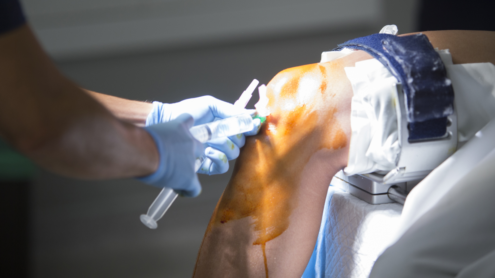 Medical procedure on a patient’s knee, showing potential clinical intervention.
