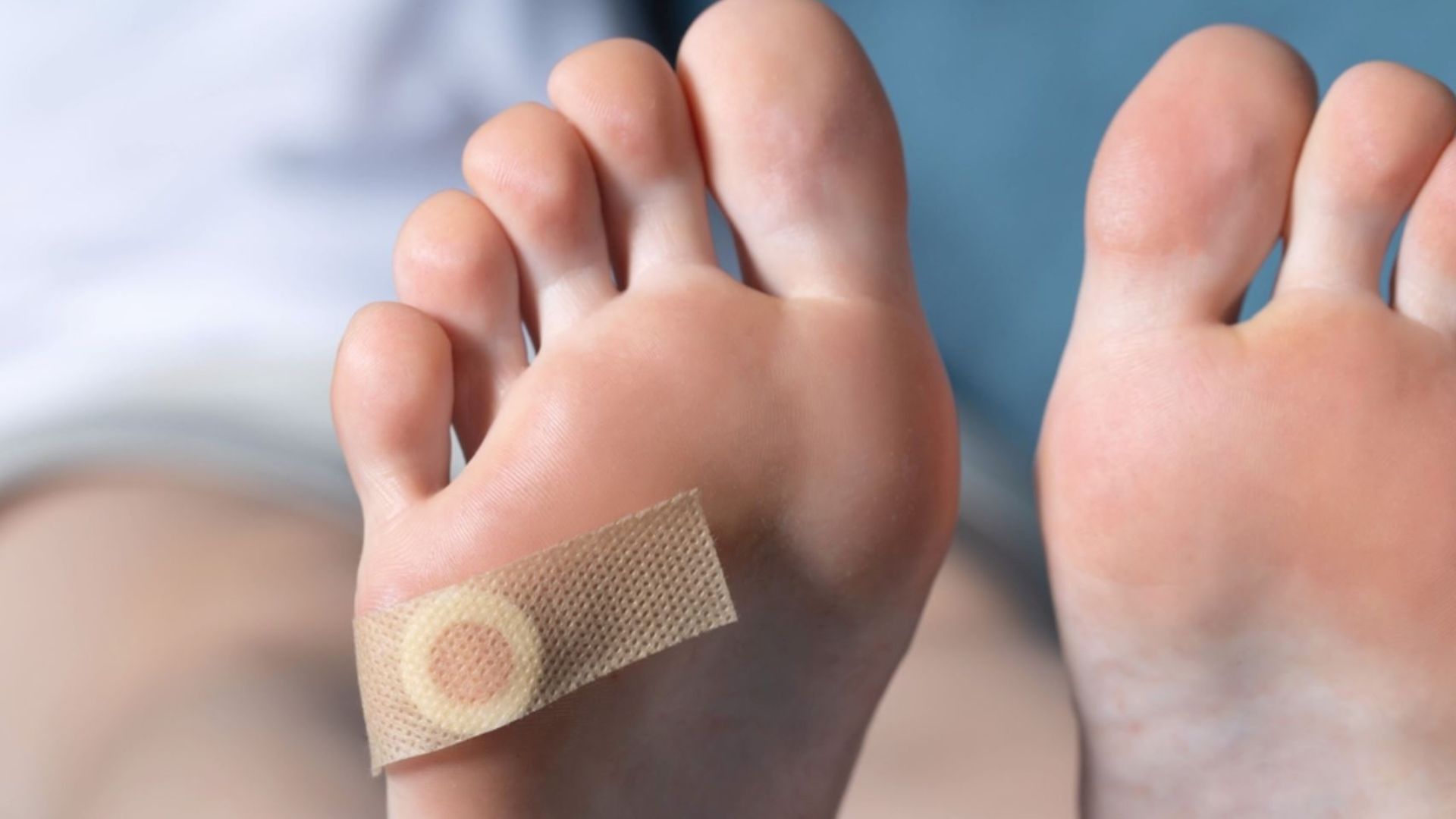 Foot with a corn plaster applied on the toe, showing common DIY method before corn removal treatment in Singapore.