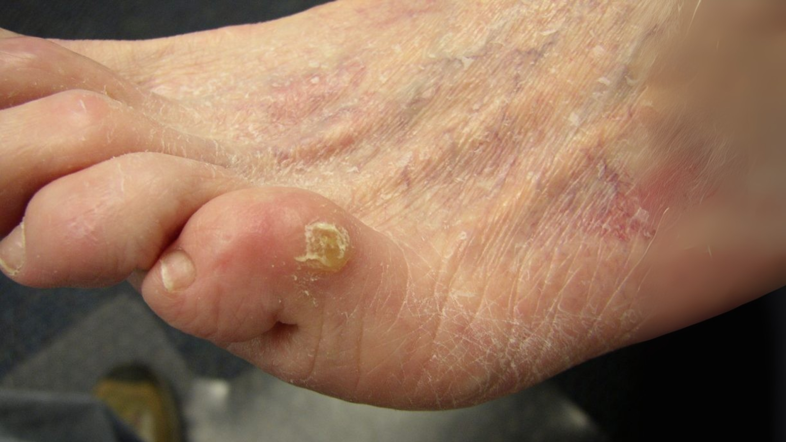 Severe corn on elderly foot requiring urgent podiatry corn removal treatment in Singapore.