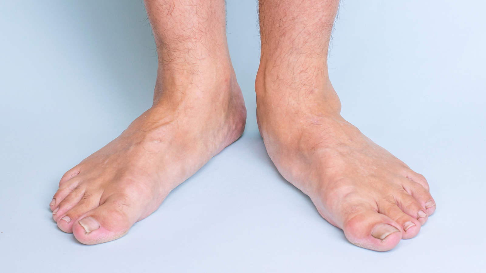 Flat feet condition leading to chronic foot pain in Singapore.