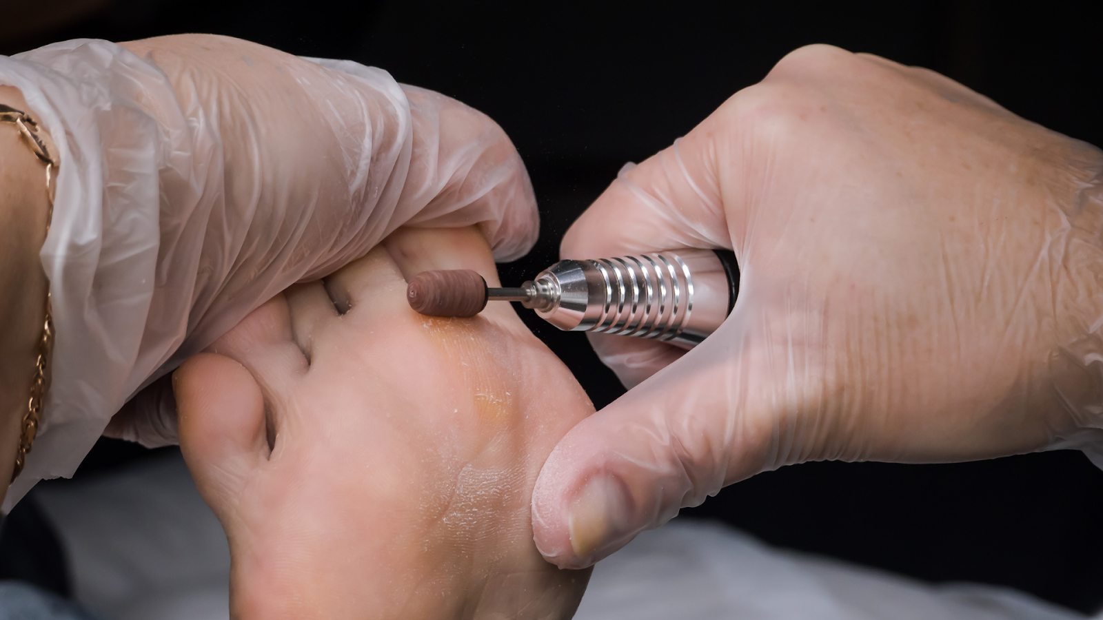 Podiatrist performing safe corn removal treatment in Singapore using a medical drill tool.